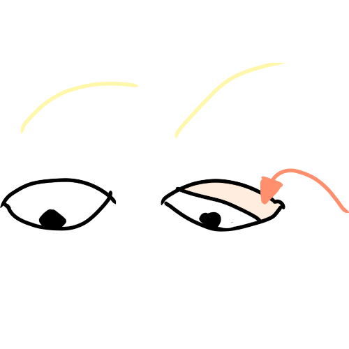 two eyes. One is wide open, but the other has a visible, light skinned eyelid that’s halfway lowered. A peach colored arrow points to the eyelid.